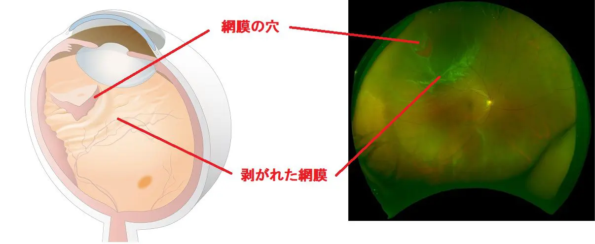 網膜剥離 | 垂水駅前たけもと眼科