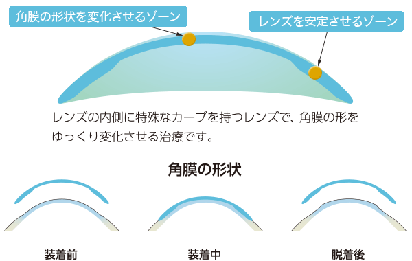 オルソケラトロジー | 垂水駅前たけもと眼科