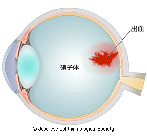 硝子体出血